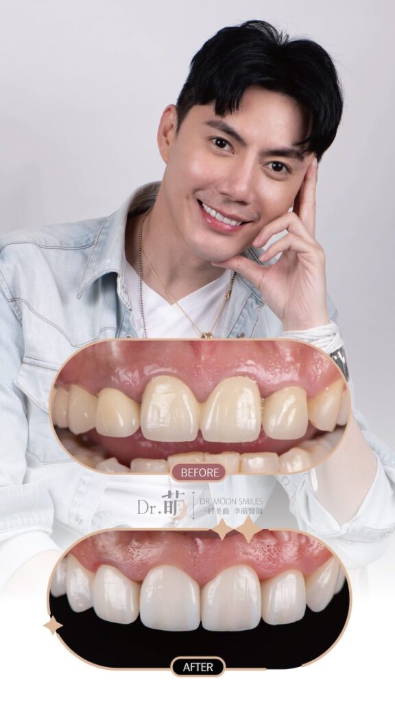 假牙重做-陶瓷貼片-全瓷冠-微笑設計-王凱-推薦-台北-李萌醫師