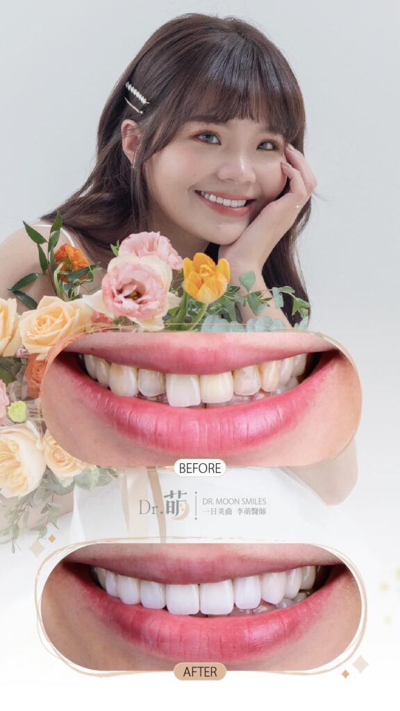 全瓷冠-陶瓷貼片-牙齒不整齊-牙齒微笑曲線-台北-推薦-李萌醫師