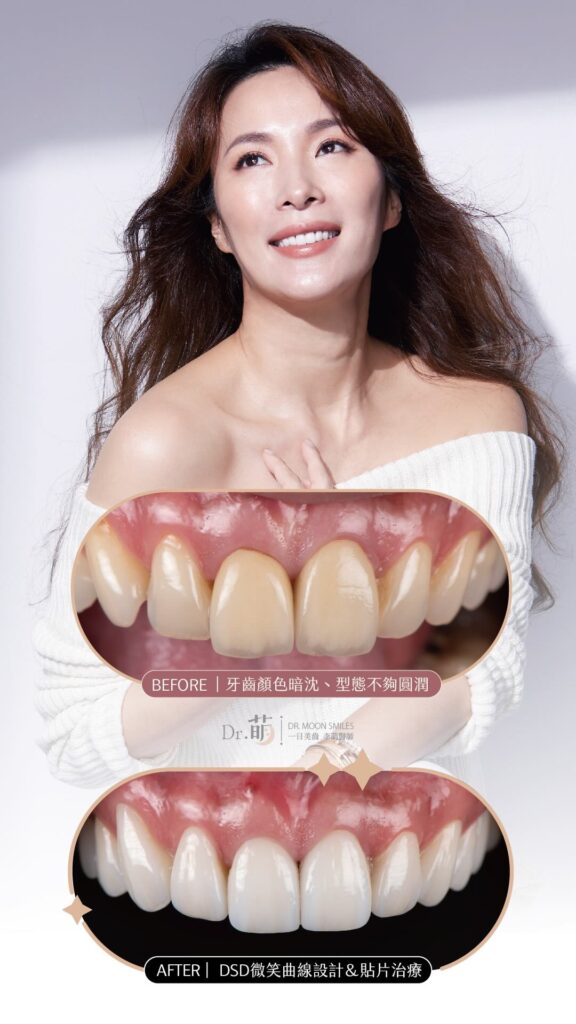 牙齒黃-牙齒美白-陶瓷貼片-DSD微笑設計-張珈瑜-推薦-台北-李萌醫師