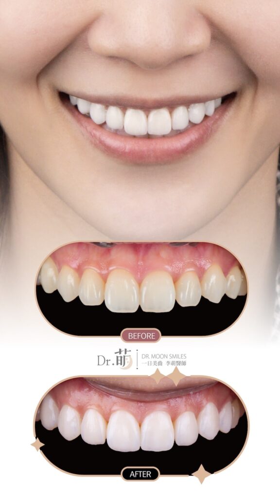 陶瓷貼片顏色-牙齒美白-陶瓷貼片-推薦-台北-李萌醫師