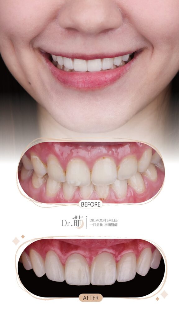 牙齒短-牙齒中線歪-微笑訓練-陶瓷貼片-推薦-三重-台北-李萌醫師
