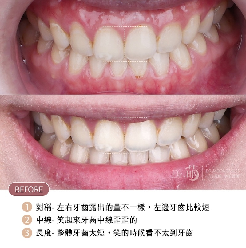 療程前牙齒近照,有排列不對稱、牙齒中線歪等問題,且整體牙齒長度偏短,笑起來看不太到牙齒