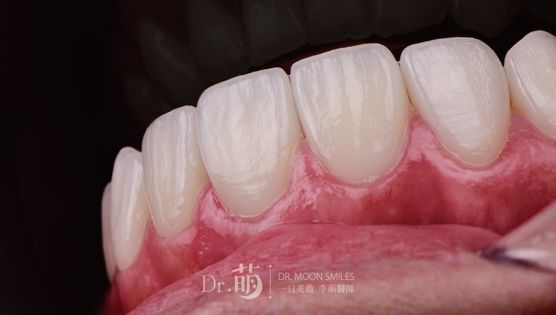 近拍陶瓷貼片細節,可見自然琺瑯質紋理與表面光澤,展現高擬真牙齒美感