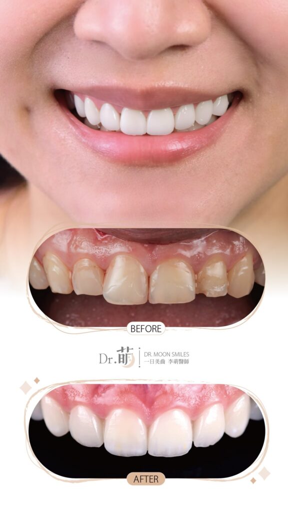 磨牙-牙齒磨損-磨牙解決方法-陶瓷貼片-推薦-板橋-台北-李萌醫師