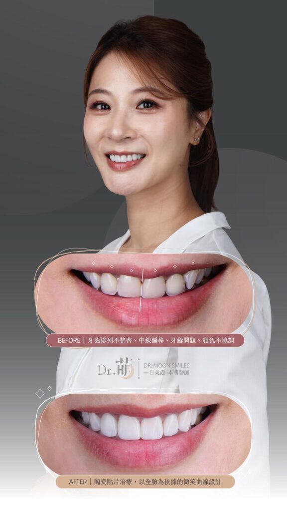 矯正牙齒跑掉-牙縫黑三角-牙齒中線偏移-陶瓷貼片-台北-推薦-李萌醫師