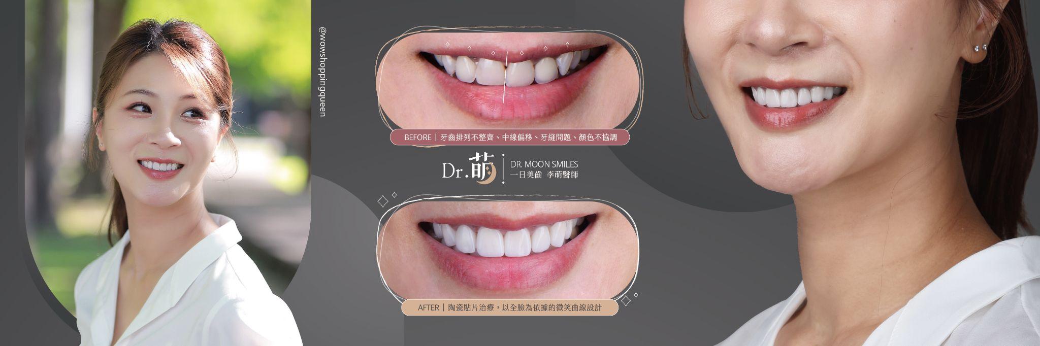陶瓷貼片-案例-矯正牙齒跑掉-牙縫黑三角-牙齒中線偏移-李萌醫師-台北-雪拼
