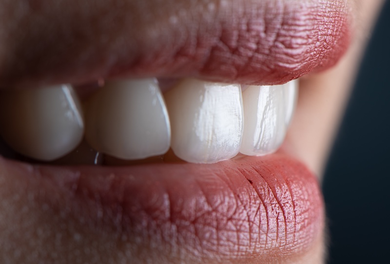 近拍陶瓷貼片裝戴後的前牙，呈現自然透亮的光澤與細緻紋理