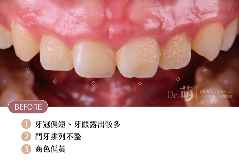 Sandy 治療前的正面口內照，圖上標示牙冠偏短、牙齦露出較多、門牙排列不整與齒色偏黃