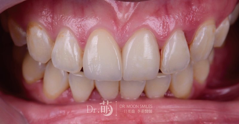 陳小姐右上中央門牙陶瓷貼片修復後口內近照,呈現兩側門牙的色彩與形態