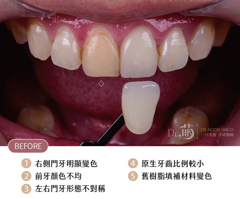 陳小姐治療前口內照,呈現門牙色差與形態
